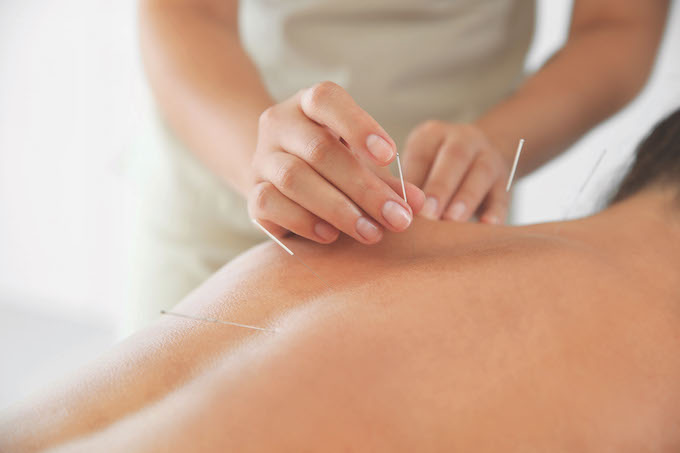 acupuncture_credit New Africa/shutterstock.com 